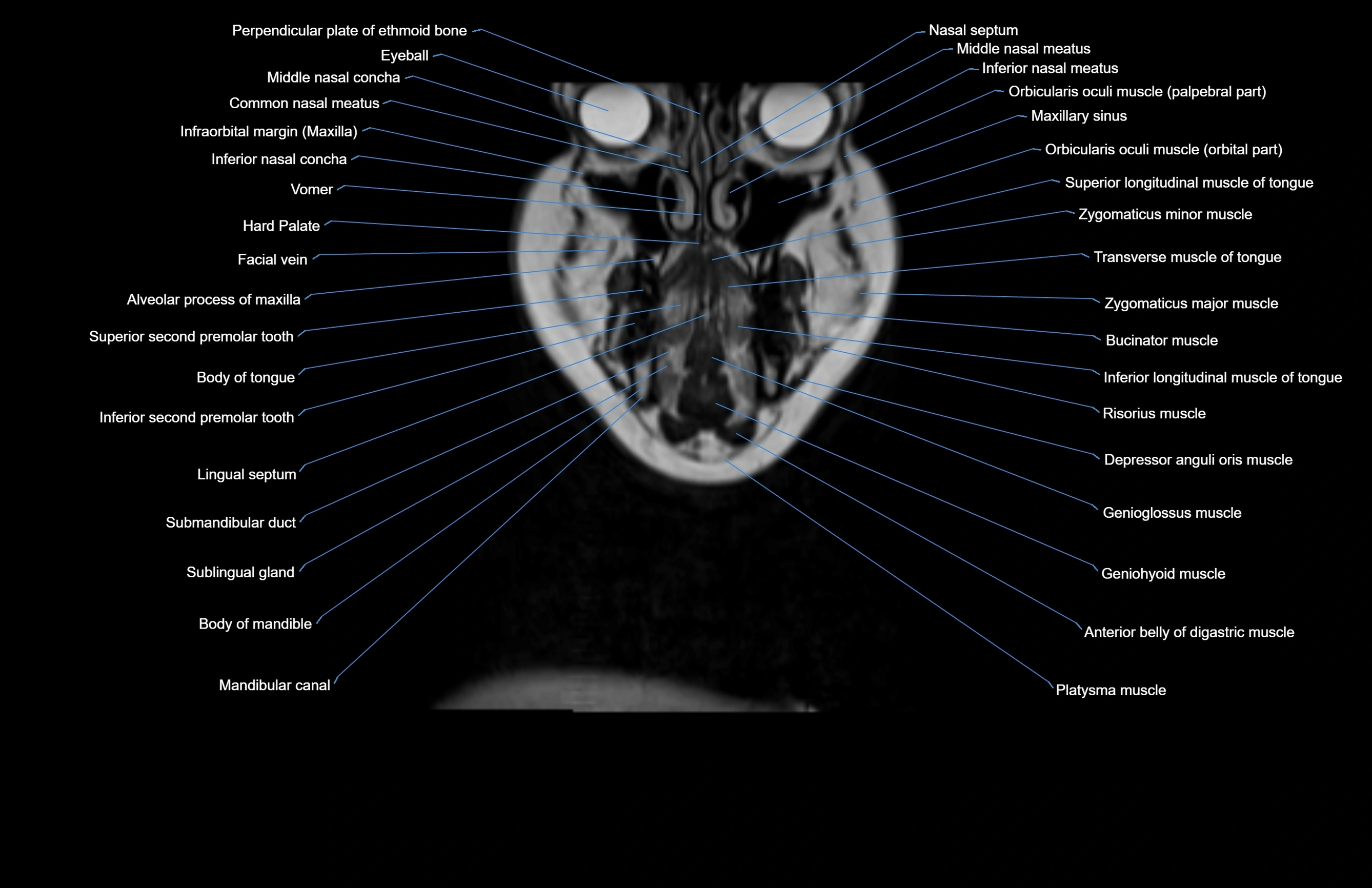 Neck coronal cross sectional MRI anatomy 3T MRI  image-img-00001-00066.webp